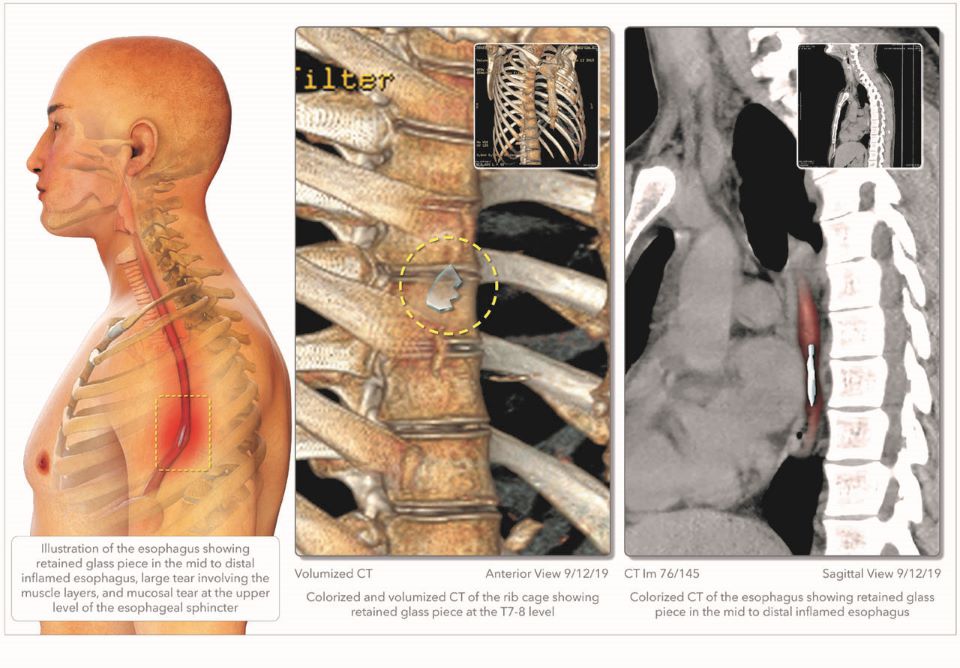 Glass In Esophagus